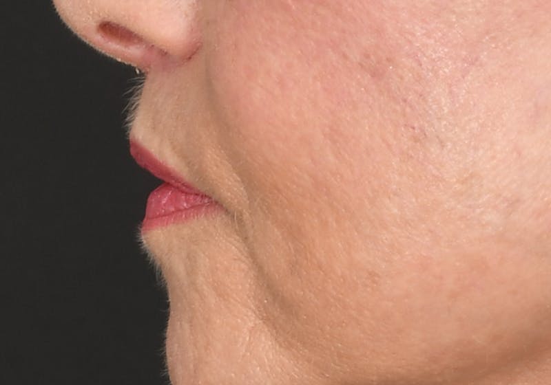 Lip Lift Before & After Gallery - Patient 429445 - Image 10