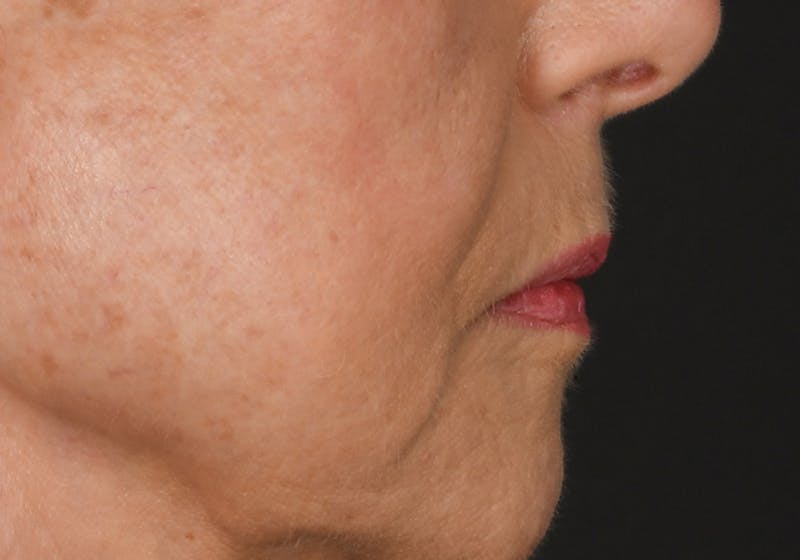 Lip Lift Before & After Gallery - Patient 429445 - Image 11