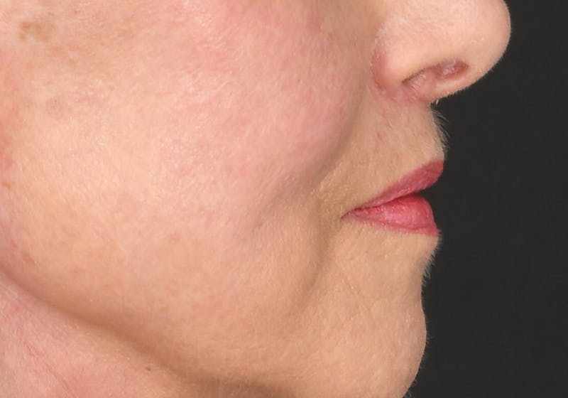 Lip Lift Before & After Gallery - Patient 429445 - Image 12
