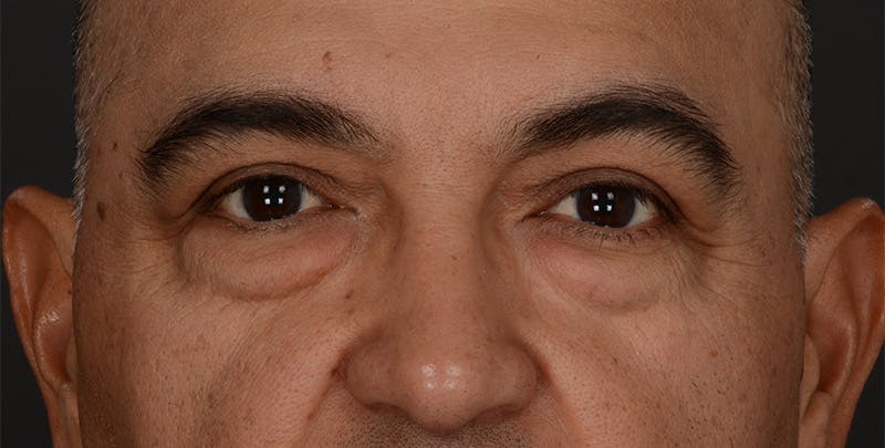 Blepharoplasty Before & After Gallery - Patient 361361 - Image 1