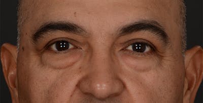Blepharoplasty Before & After Gallery - Patient 361361 - Image 1