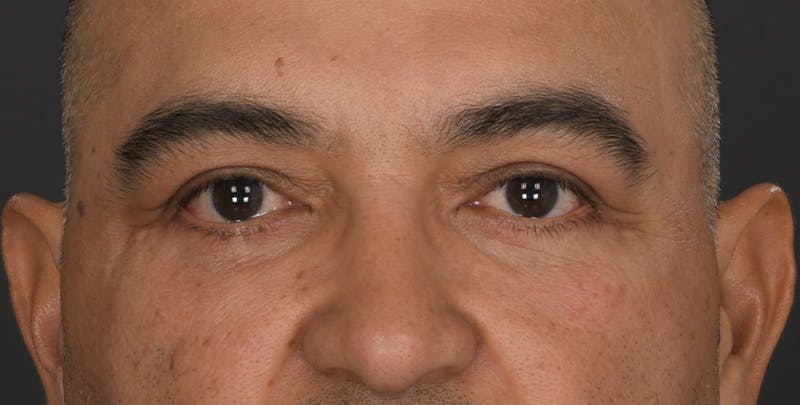Blepharoplasty Before & After Gallery - Patient 361361 - Image 2