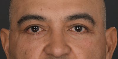 Blepharoplasty Before & After Gallery - Patient 361361 - Image 2