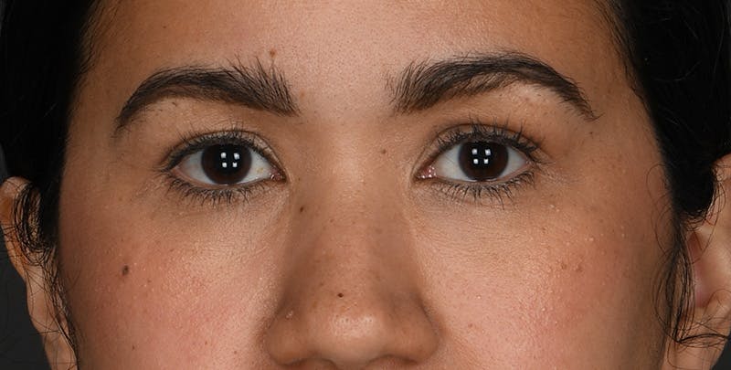 Blepharoplasty Before & After Gallery - Patient 428063 - Image 1