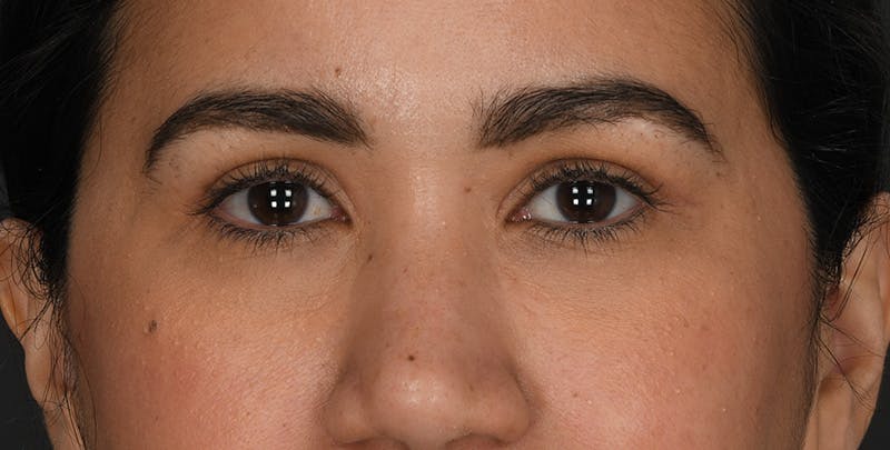 Blepharoplasty Before & After Gallery - Patient 428063 - Image 2
