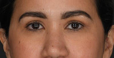 Blepharoplasty Before & After Gallery - Patient 428063 - Image 2