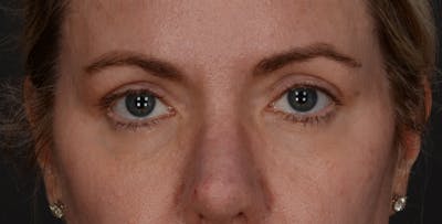 Blepharoplasty Before & After Gallery - Patient 879692 - Image 2
