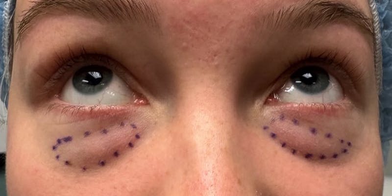 Blepharoplasty Before & After Gallery - Patient 342096 - Image 1