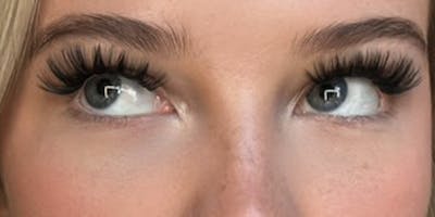 Blepharoplasty Before & After Gallery - Patient 342096 - Image 2