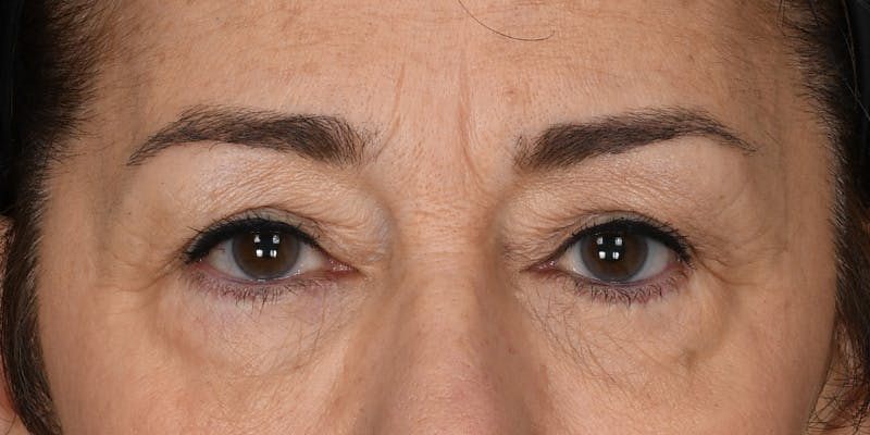 Blepharoplasty Before & After Gallery - Patient 745286 - Image 1
