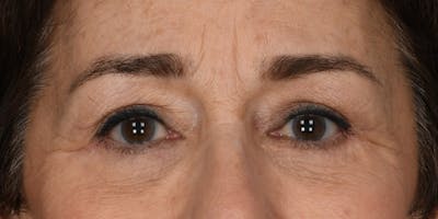 Blepharoplasty Before & After Gallery - Patient 745286 - Image 2