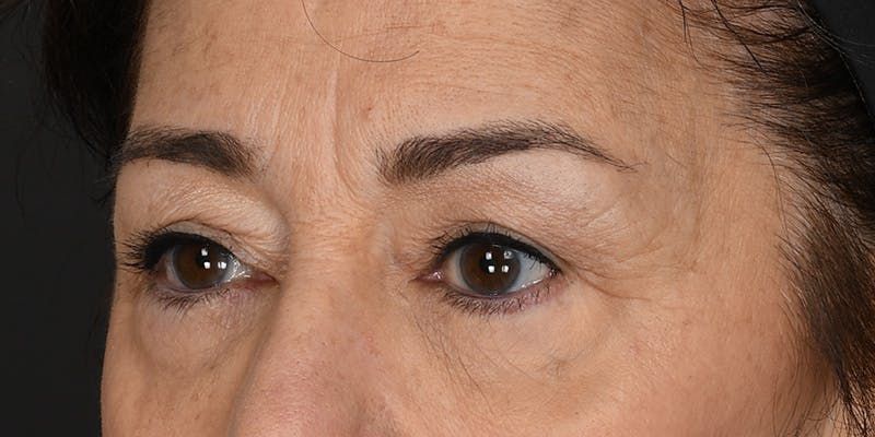 Blepharoplasty Before & After Gallery - Patient 745286 - Image 3