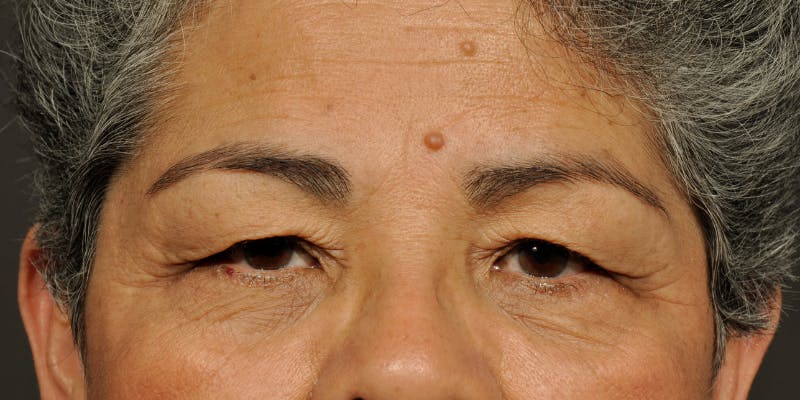 Blepharoplasty Before & After Gallery - Patient 239350 - Image 1