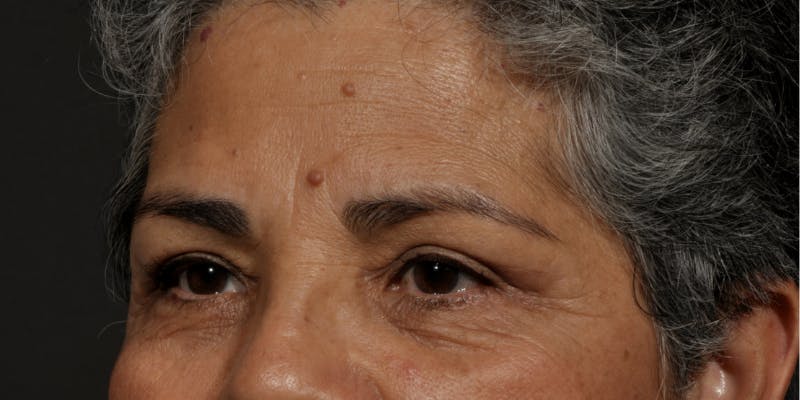 Blepharoplasty Before & After Gallery - Patient 239350 - Image 4