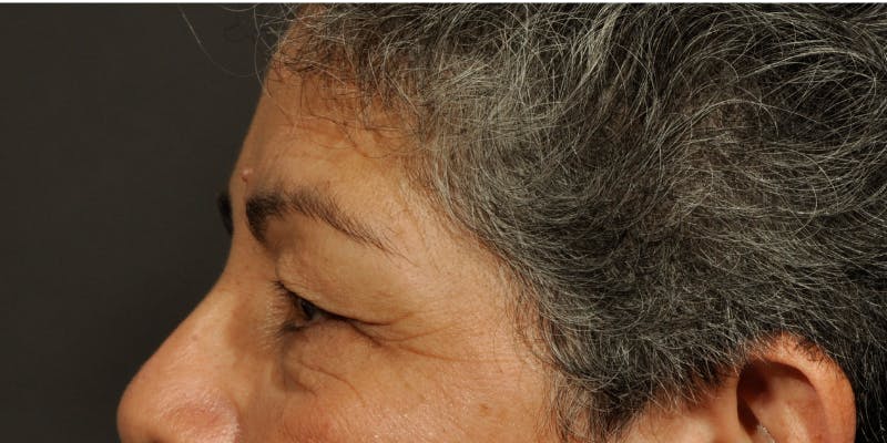Blepharoplasty Before & After Gallery - Patient 239350 - Image 5