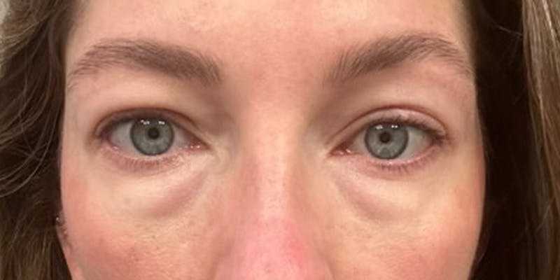 Blepharoplasty Before & After Gallery - Patient 320908 - Image 1