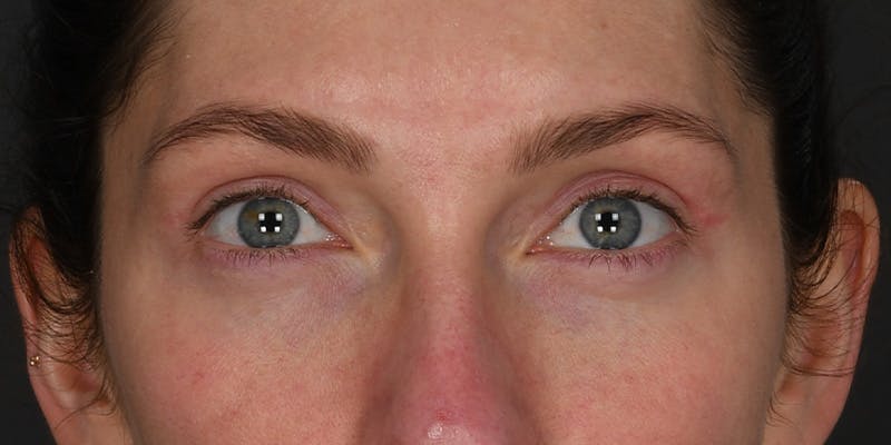 Blepharoplasty Before & After Gallery - Patient 320908 - Image 2