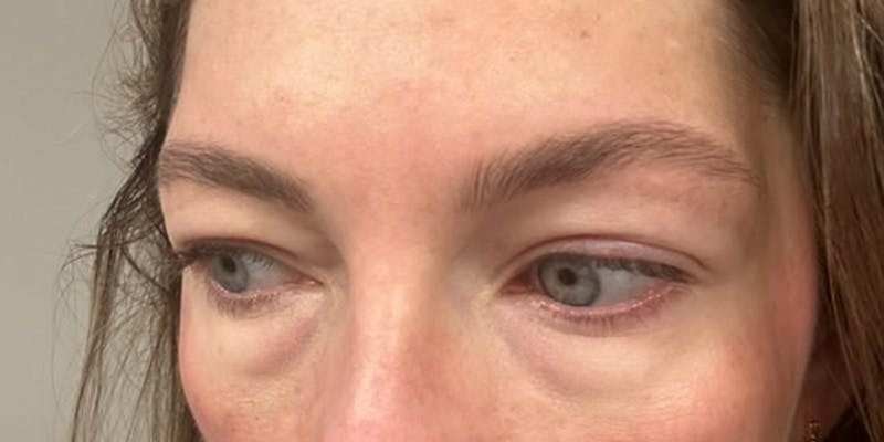 Blepharoplasty Before & After Gallery - Patient 320908 - Image 5