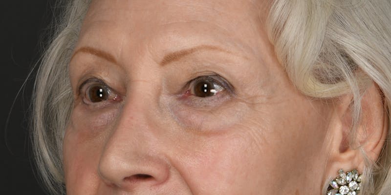 Blepharoplasty Before & After Gallery - Patient 176067 - Image 1