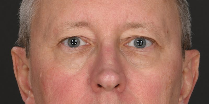 Blepharoplasty Before & After Gallery - Patient 335061 - Image 1