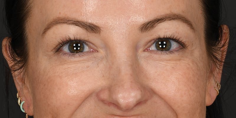 Blepharoplasty Before & After Gallery - Patient 133851 - Image 1