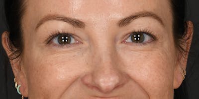 Blepharoplasty Before & After Gallery - Patient 133851 - Image 1
