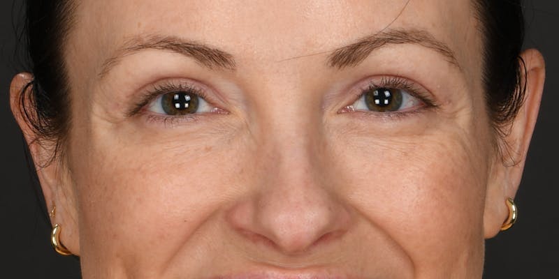 Blepharoplasty Before & After Gallery - Patient 133851 - Image 2