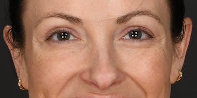Blepharoplasty Before & After Gallery - Patient 133851 - Image 2