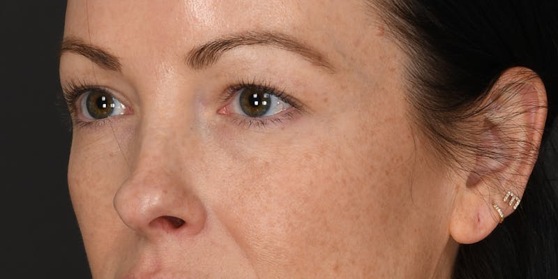 Blepharoplasty Before & After Gallery - Patient 133851 - Image 3