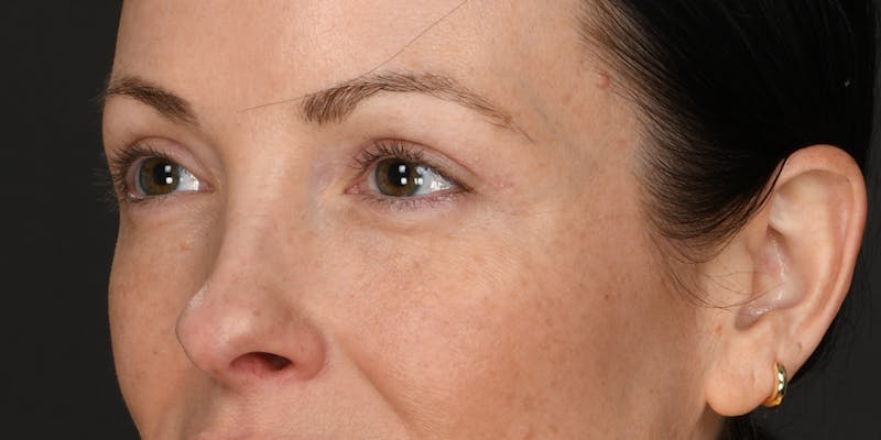 Blepharoplasty Before & After Gallery - Patient 133851 - Image 4