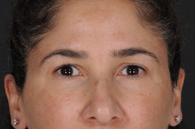 Blepharoplasty Before & After Gallery - Patient 659936 - Image 1