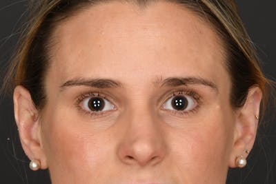 Blepharoplasty Before & After Gallery - Patient 237543 - Image 1