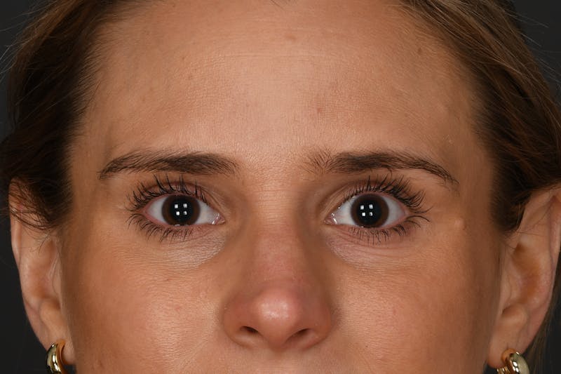 Blepharoplasty Before & After Gallery - Patient 237543 - Image 2