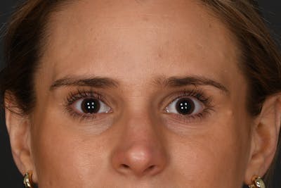 Blepharoplasty Before & After Gallery - Patient 237543 - Image 2