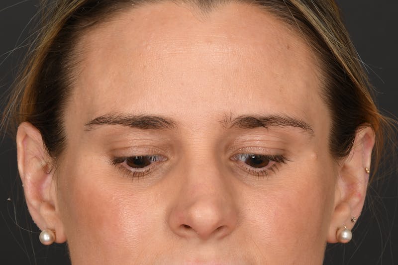 Blepharoplasty Before & After Gallery - Patient 237543 - Image 3