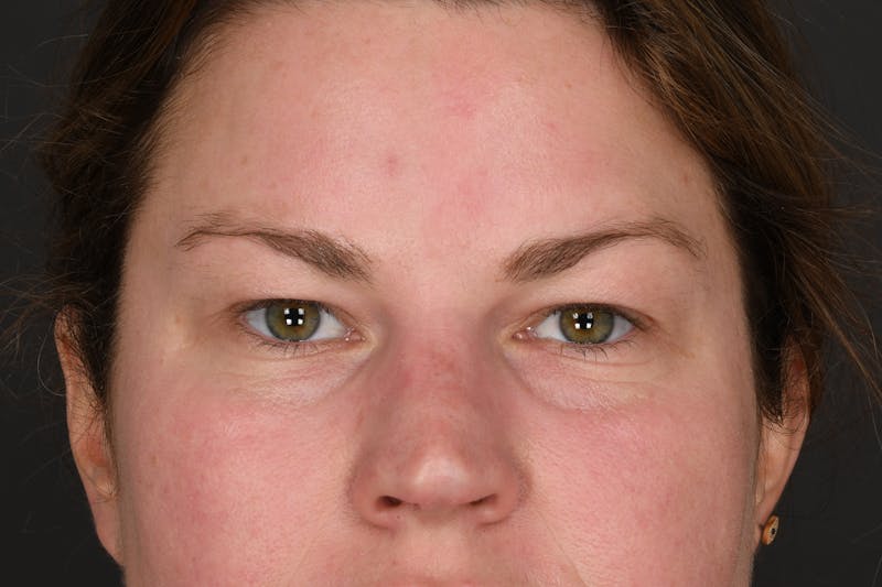 Blepharoplasty Before & After Gallery - Patient 122424 - Image 1