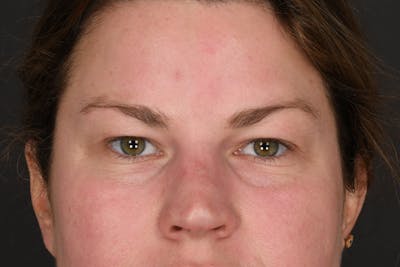 Blepharoplasty Before & After Gallery - Patient 122424 - Image 1