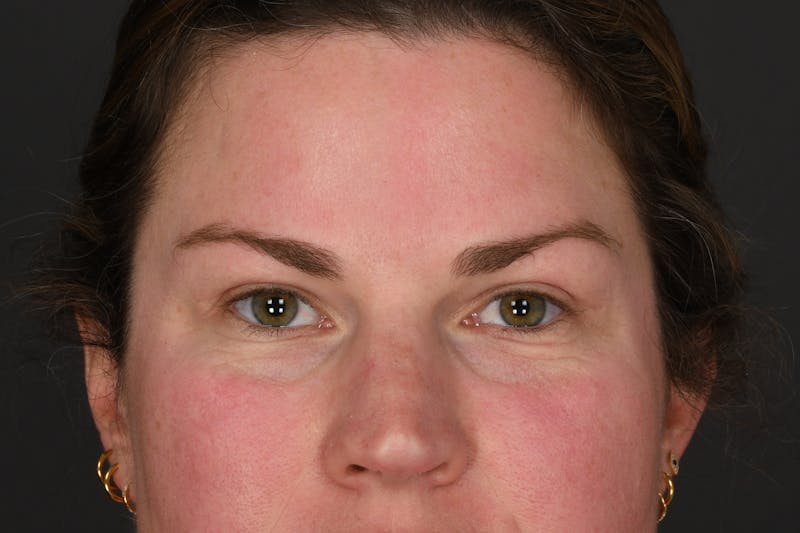 Blepharoplasty Before & After Gallery - Patient 122424 - Image 2