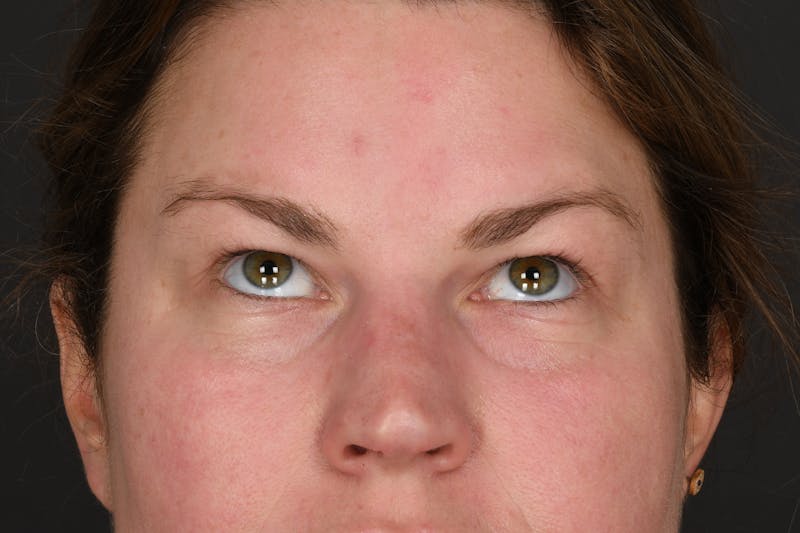 Blepharoplasty Before & After Gallery - Patient 122424 - Image 3