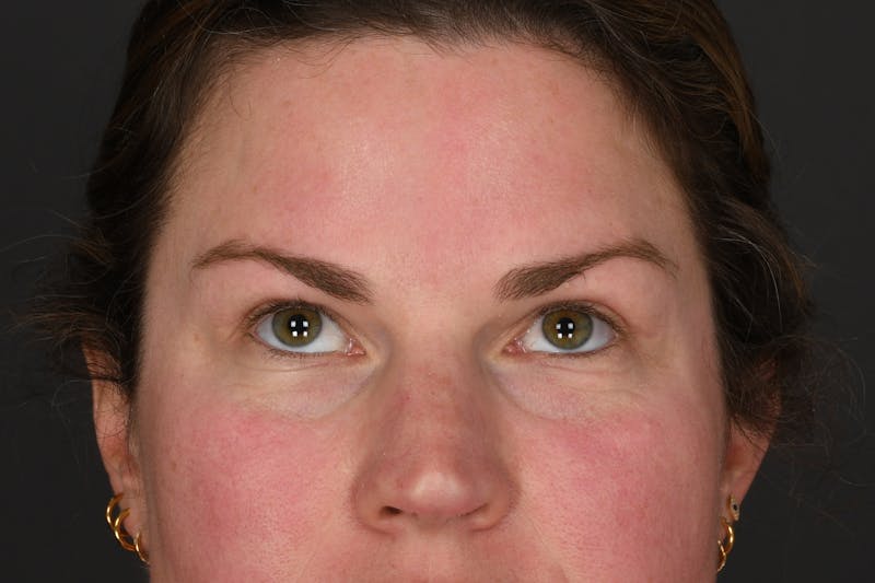 Blepharoplasty Before & After Gallery - Patient 122424 - Image 4