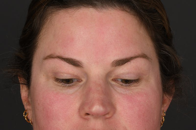 Blepharoplasty Before & After Gallery - Patient 122424 - Image 6