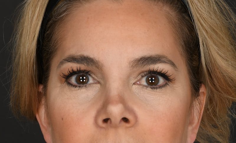 Blepharoplasty Before & After Gallery - Patient 409895 - Image 1