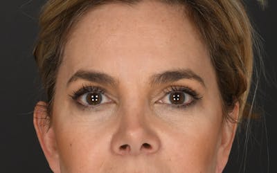 Blepharoplasty Before & After Gallery - Patient 409895 - Image 2