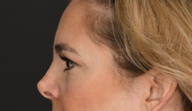 Blepharoplasty Before & After Gallery - Patient 409895 - Image 5