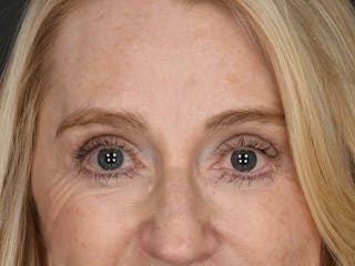 Blepharoplasty Before & After Gallery - Patient 356520 - Image 2