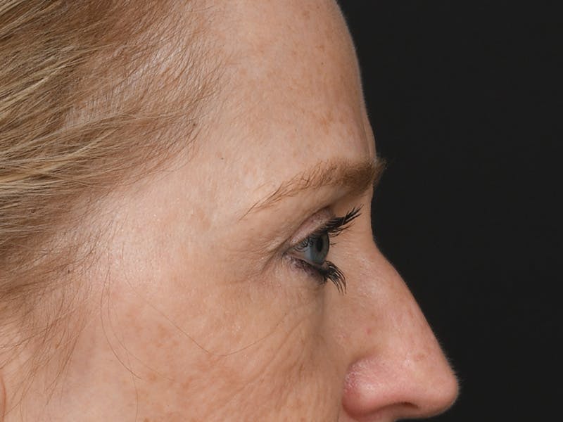 Blepharoplasty Before & After Gallery - Patient 356520 - Image 5