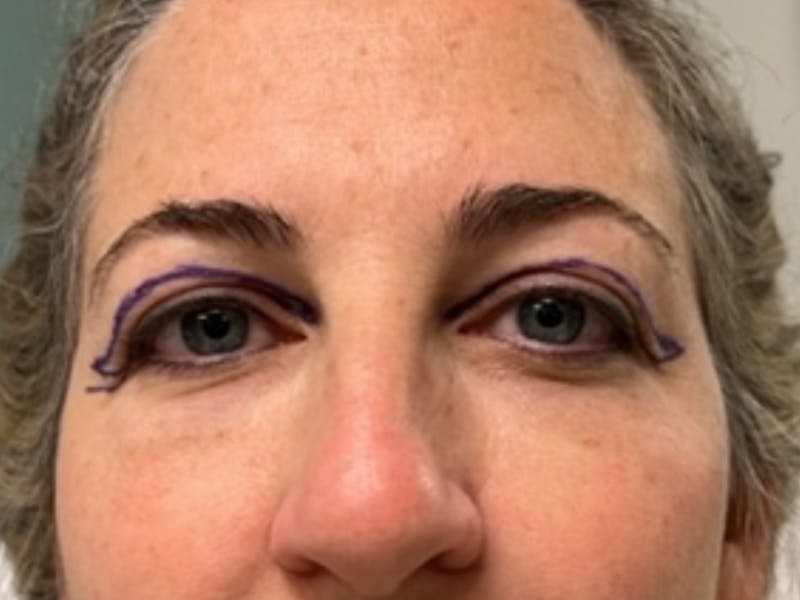 Blepharoplasty Before & After Gallery - Patient 154348 - Image 1