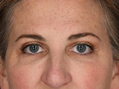 Blepharoplasty Before & After Gallery - Patient 154348 - Image 2
