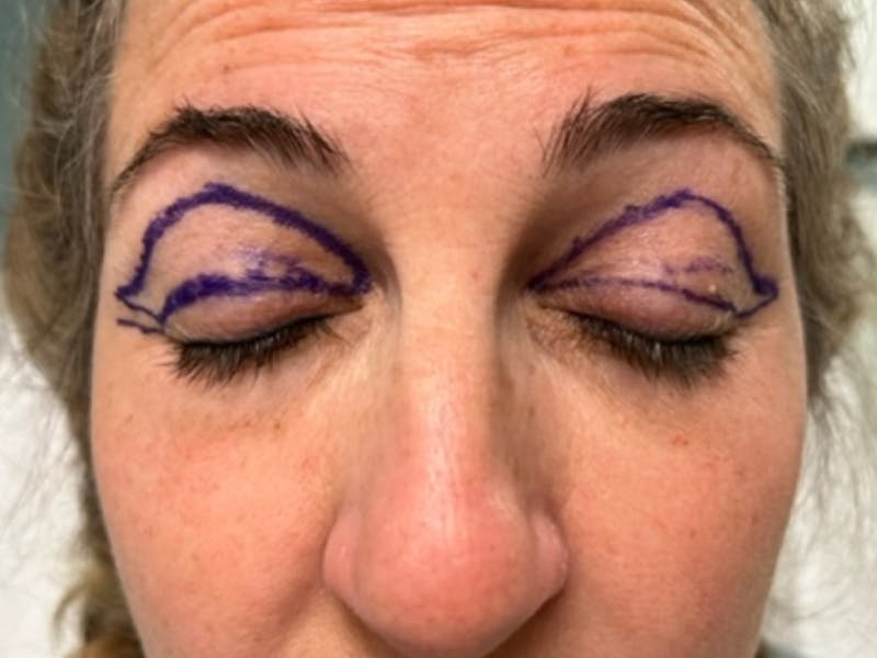 Blepharoplasty Before & After Gallery - Patient 154348 - Image 3