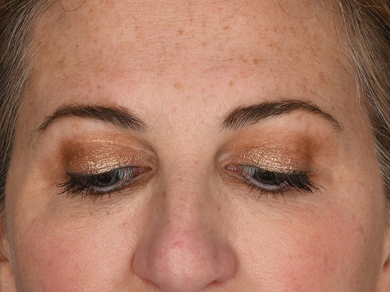 Blepharoplasty Before & After Gallery - Patient 154348 - Image 4
